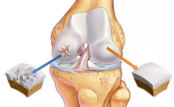 Cartilage sain et arthrose de l'articulation