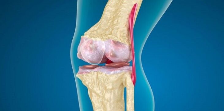 Endommager l'articulation du genou pour l'arthrose